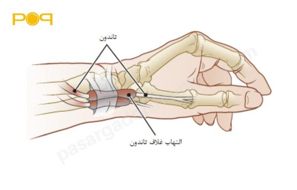 سندروم دکرون چیست؟