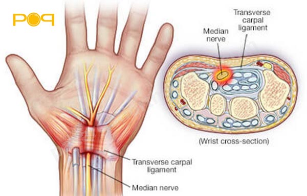 بررسی آناتومی تونل کارپال