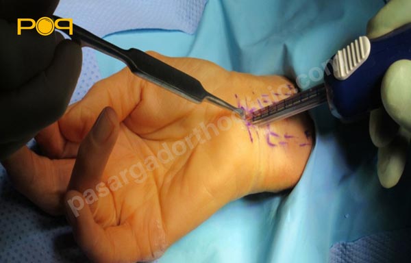 درمان سندروم تونل کارپال با جراحی
