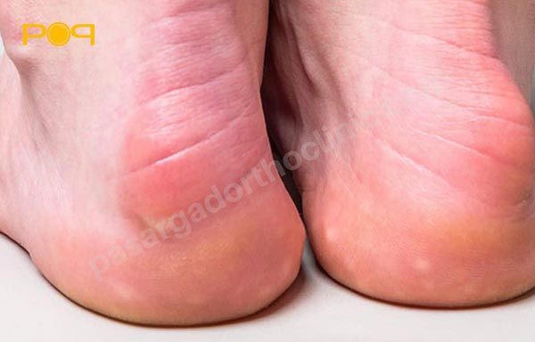 بورسیت پاشنه پا یا Heel bursitis