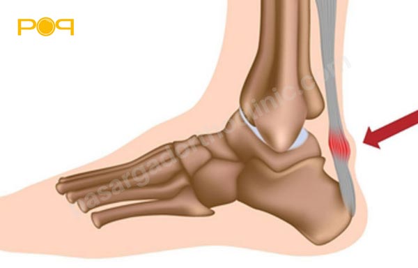 تاندون آشیل کجای پا واقع است؟