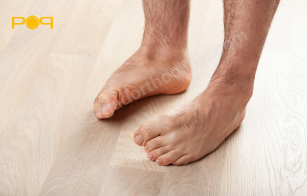 تشخیص گودی کف پا در خانه