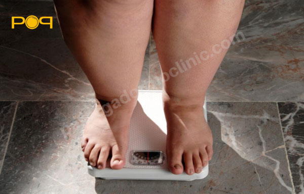 چاقی از عوامل موثر بر کف پای گودی شکل