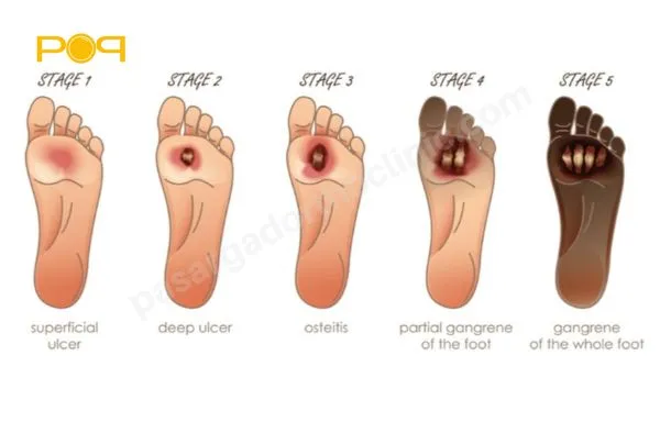 دلیل قطع عضو پا در افراد دیابتی