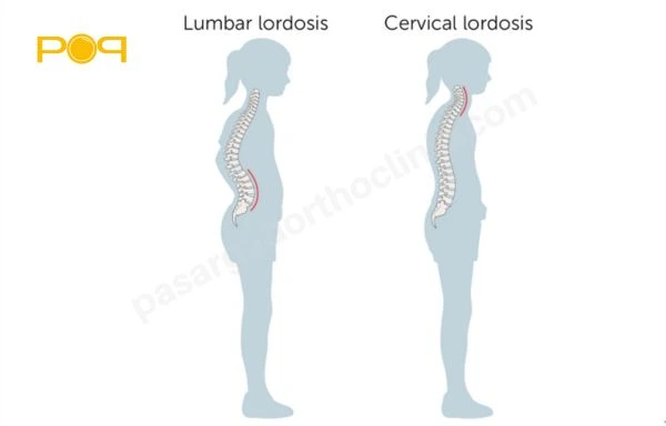 راه‌های تشخیص لوردوز کمری
