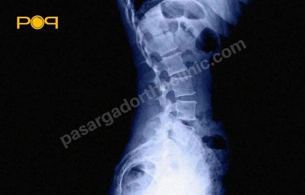 علائم لوردوز کمری