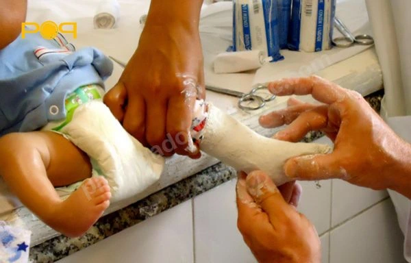 روش گچ‌گیری در درمان پاچنبری