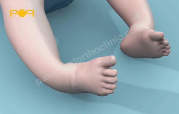 چیستی، علائم، علل بروز و روش تشخیص پا چنبری